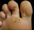/album/fotos/verruga-plantar-jpg/